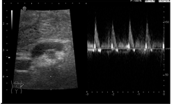 MALS (Median Arkuat Ligaman Sendromu) nedir?
