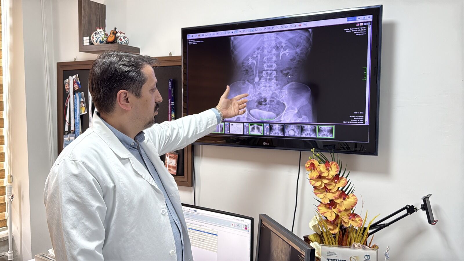 Doktorlar Bile Şaşırdı! Genç Kadının Üreterinden 51 Taş Çıkarıldı (4)